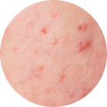 acne.png